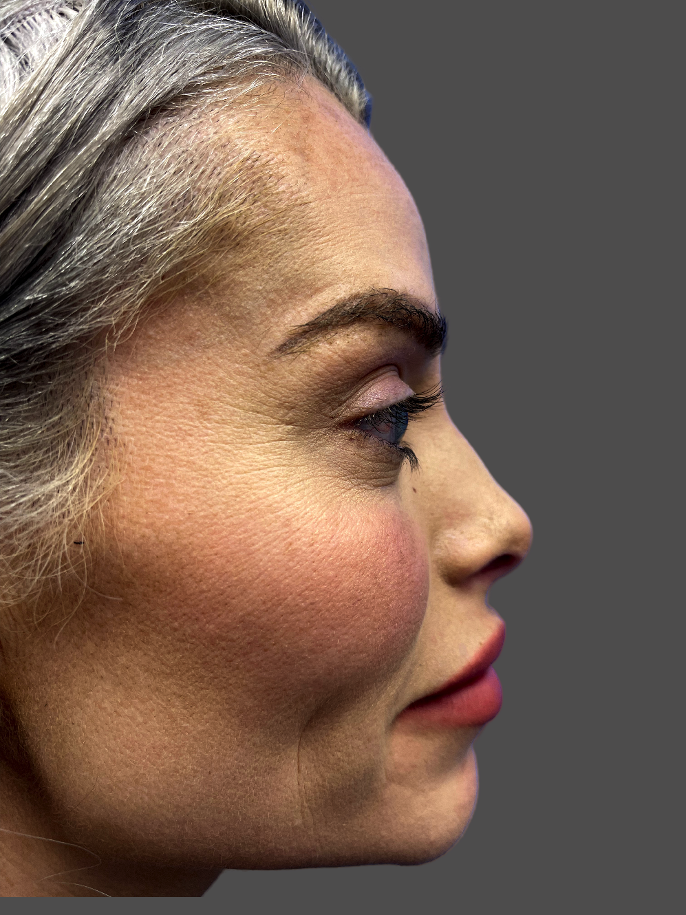 Case--4580-Rhinoplasty | After Rhinoplasty