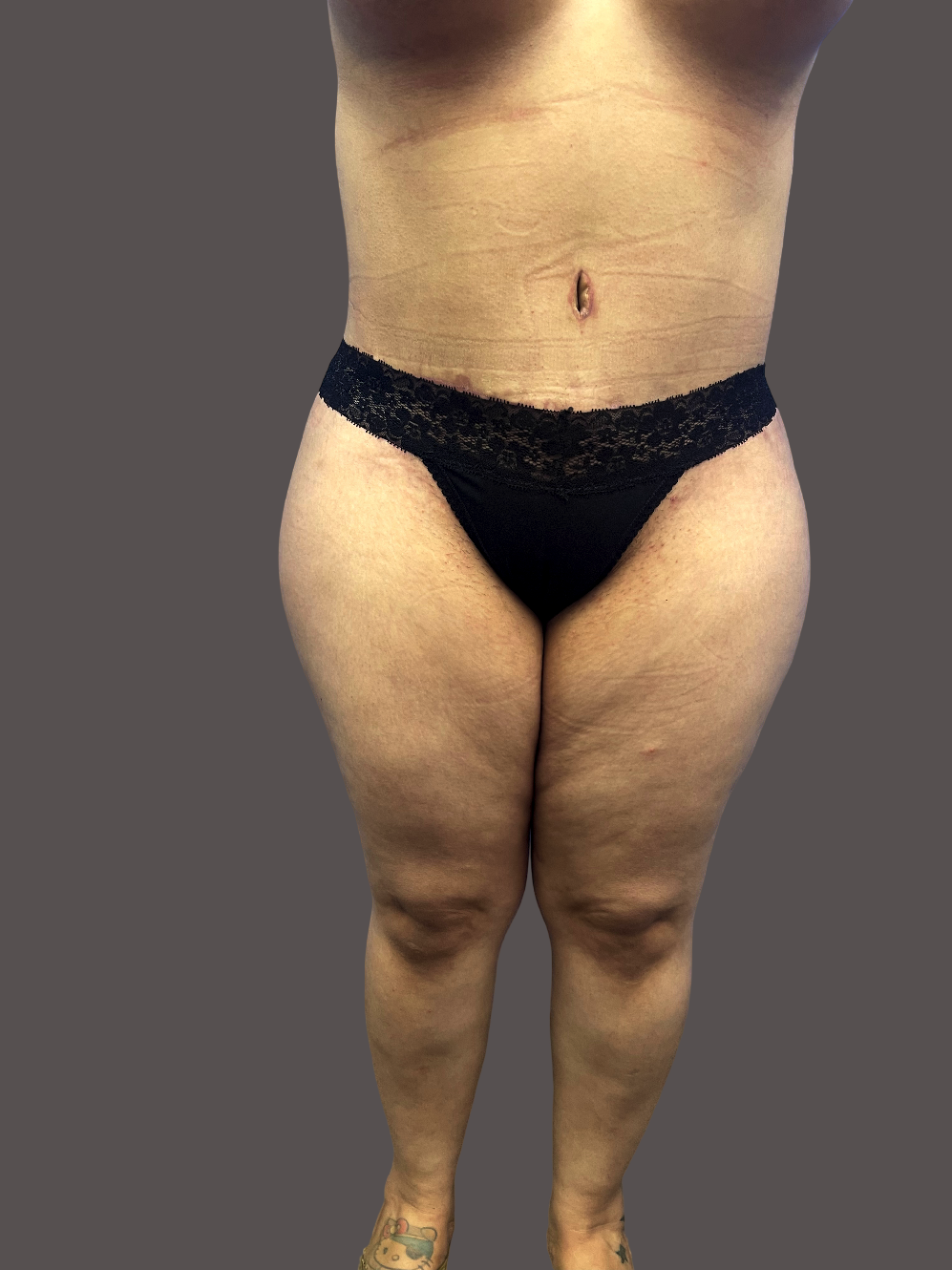 Case--3727-Tummy-Tuck | After Tummy Tuck