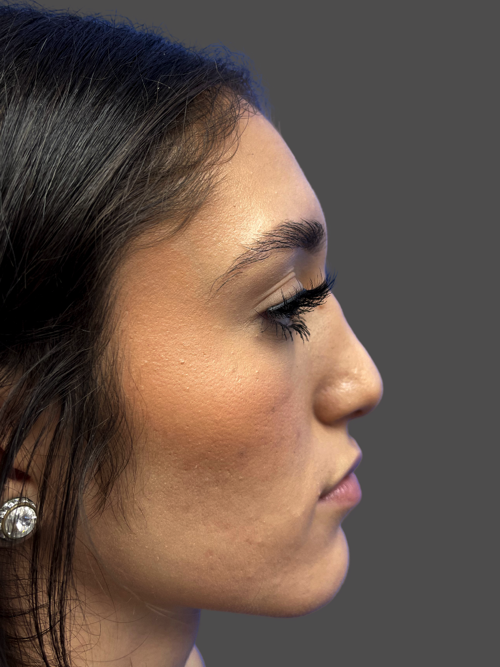 Case--1332-Rhinoplasty | After Rhinoplasty