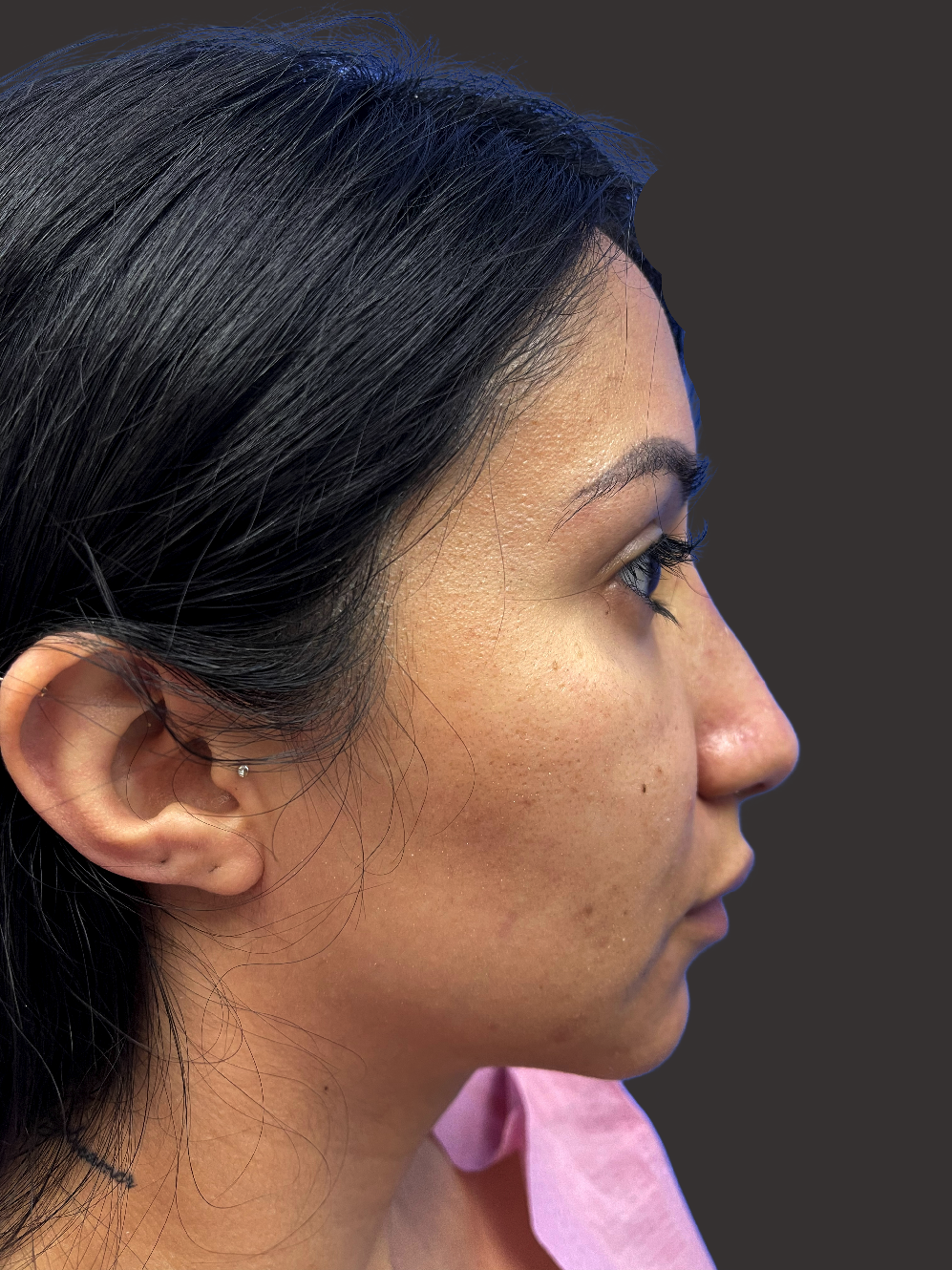 Case--8106-Rhinoplasty | After Rhinoplasty