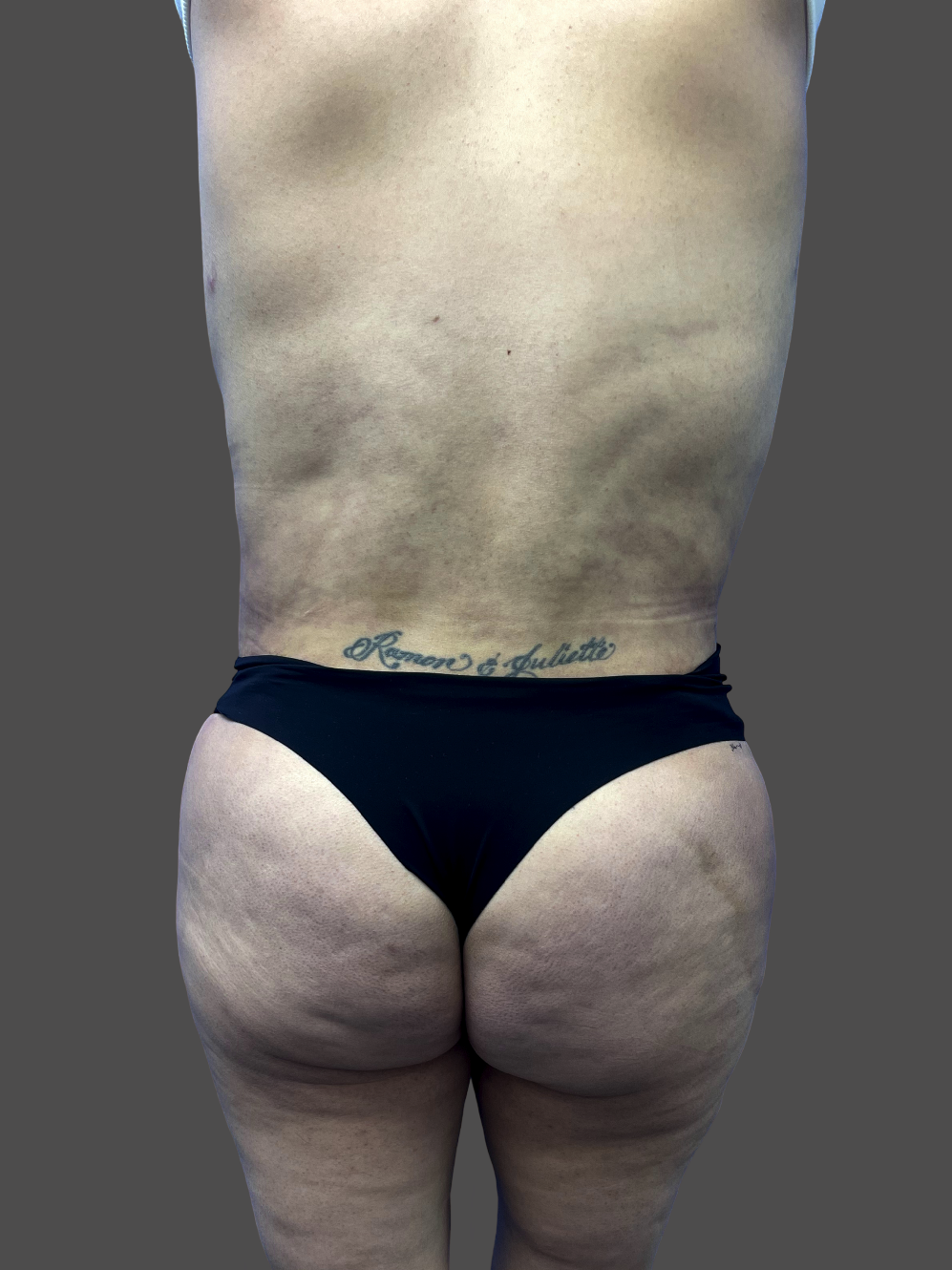 Case--8703-Liposuction | After Body