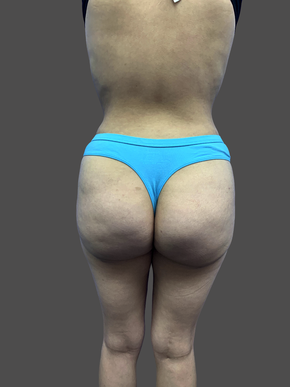 Case--7658-Liposuction | After Body
