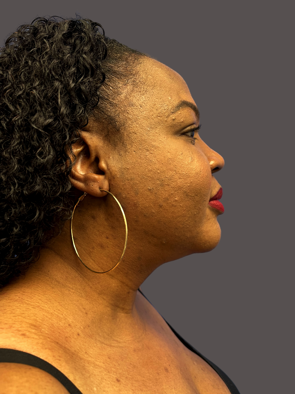 Case--8662-Neck-Liposuction | After Neck Liposuction