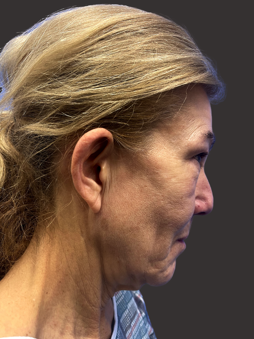 facelift beverly hills