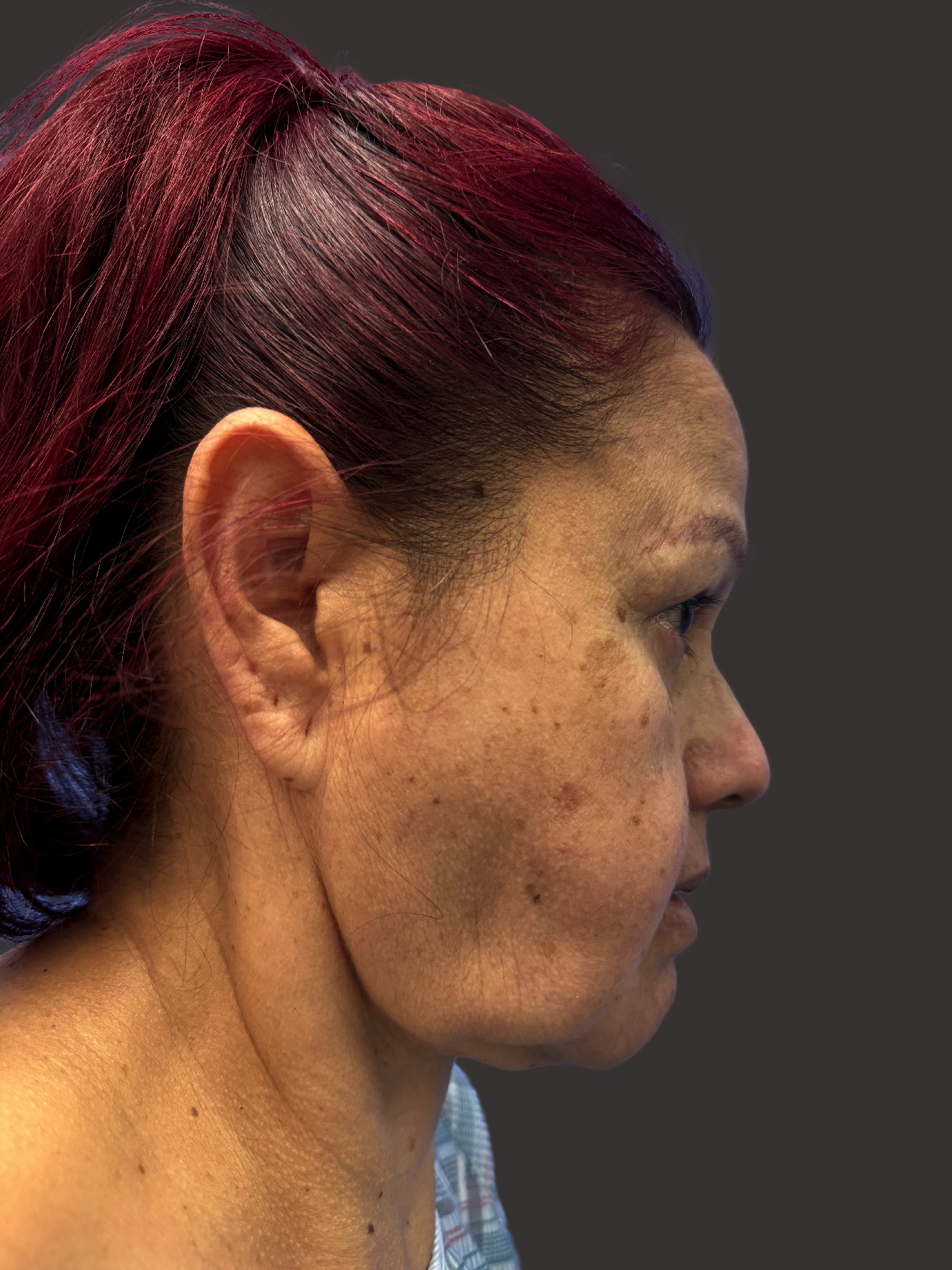 Case--4572-Facelift | Before Facelift