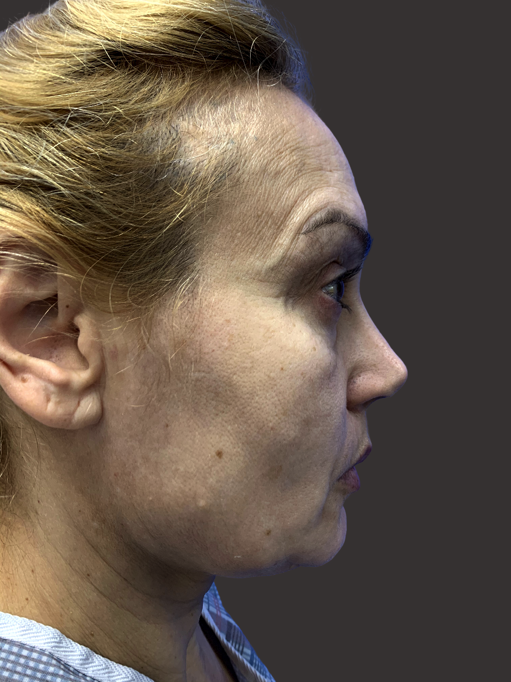 Case--2696-Facelift | Before Facelift