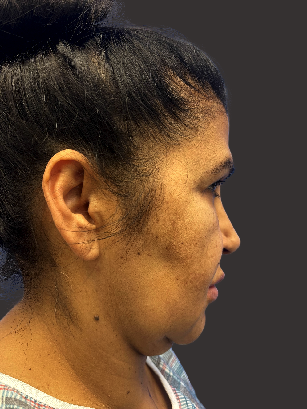 Case--7590-Facelift | Before Facelift