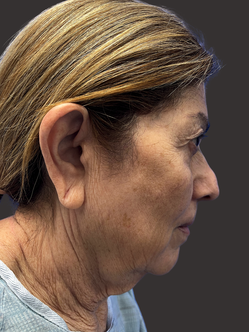 Case--8587-Facelift | Before Facelift