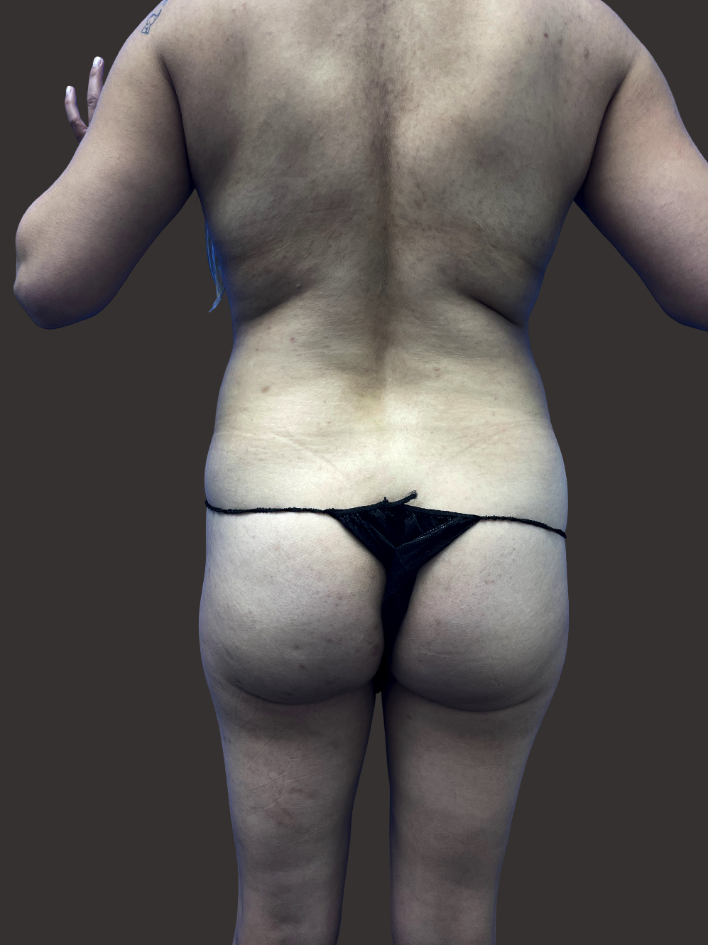 Case--4214-Brazilian-Butt-Lift | Before Body