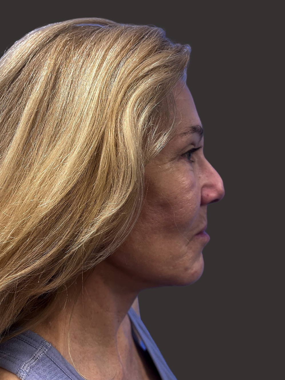 facelift beverly hills