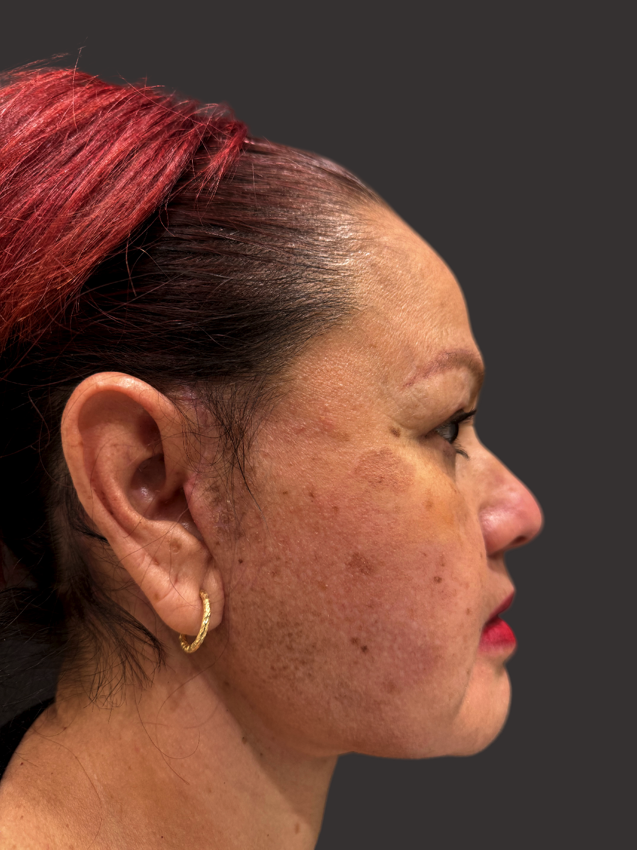 Case--4572-Facelift | After Facelift