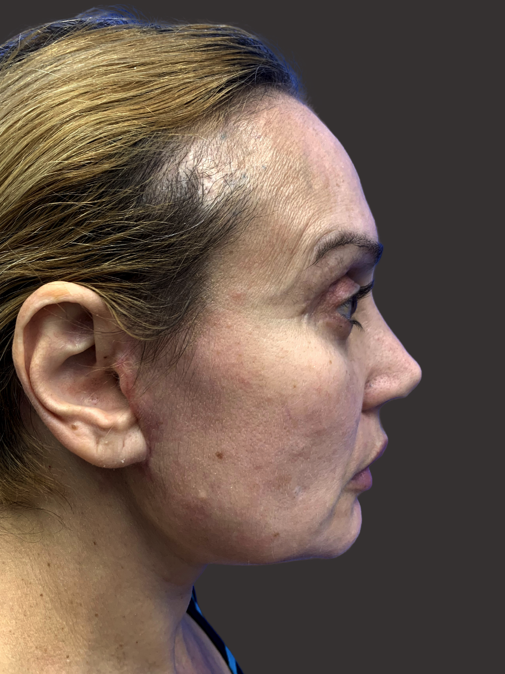 Case--2696-Facelift | After Facelift