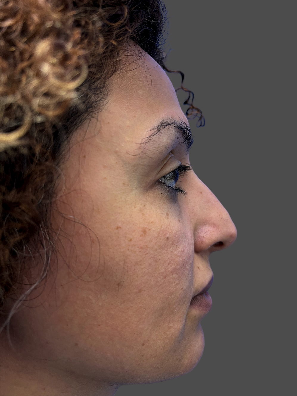 Case--5666-Rhinoplasty | Before Rhinoplasty