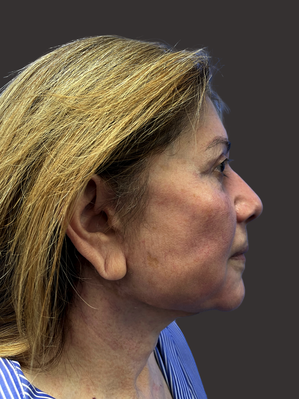 Case--8587-Facelift | After Facelift