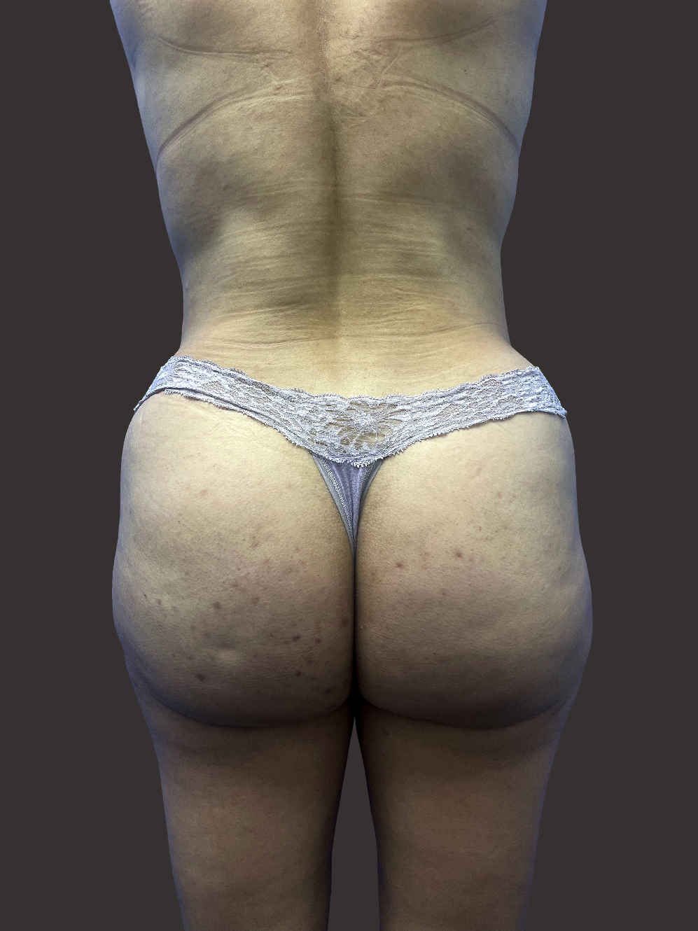Case--4214-Brazilian-Butt-Lift | After Body