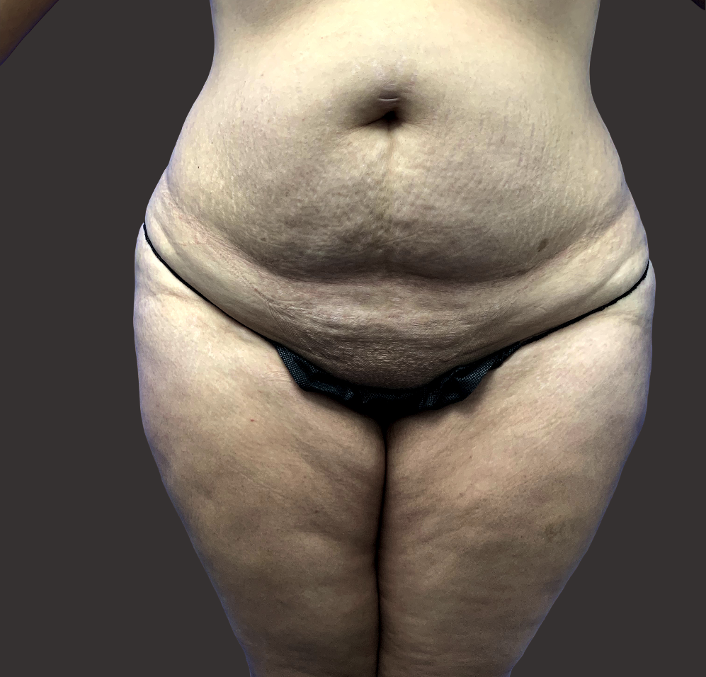 Case--8285-Tummy-Tuck | Before Tummy Tuck