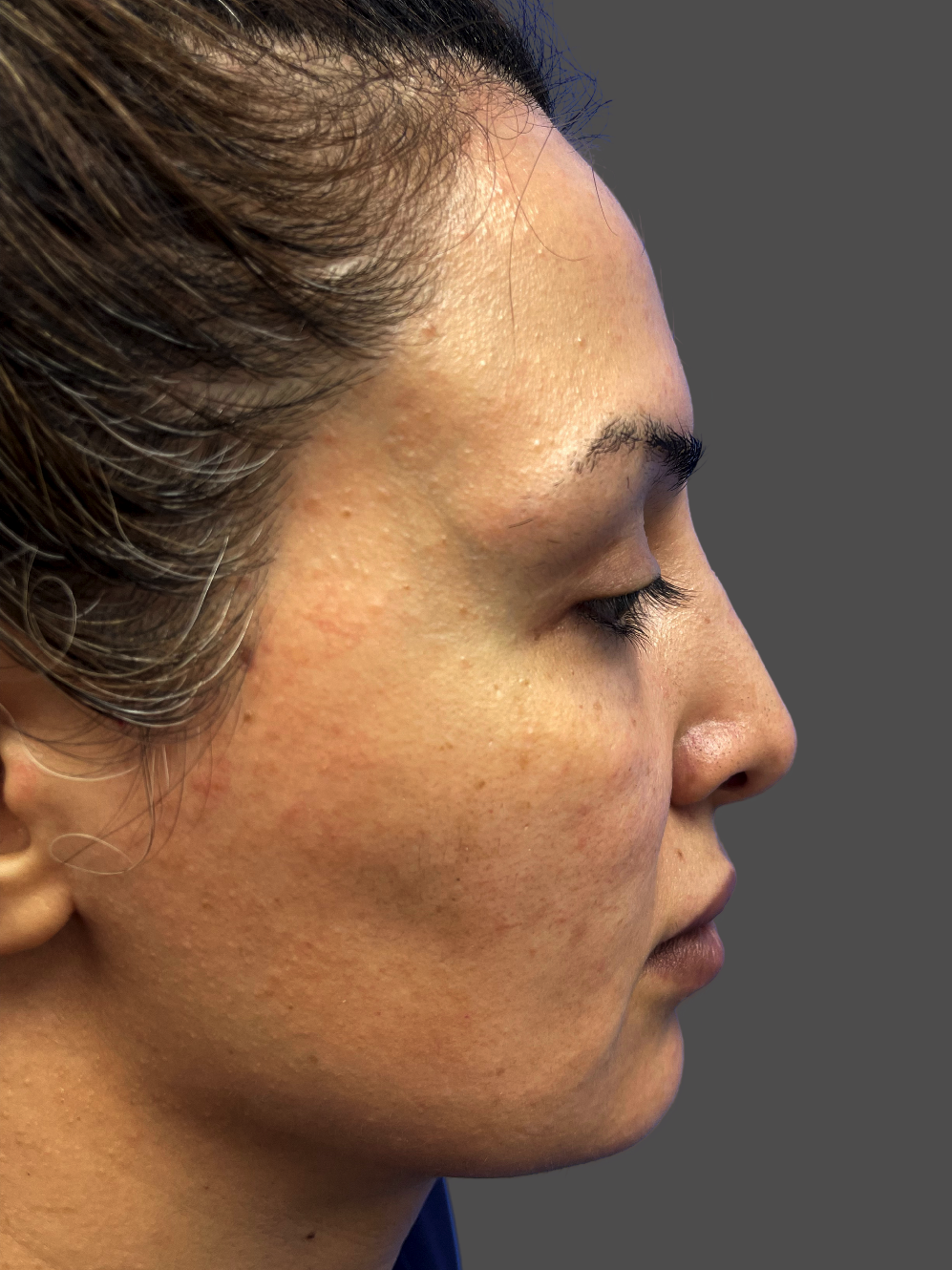 Case--5666-Rhinoplasty | After Rhinoplasty