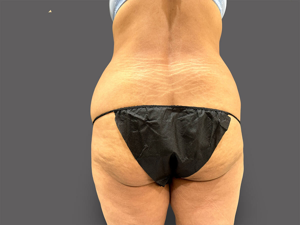 Case--3307-Liposuction | Before Body