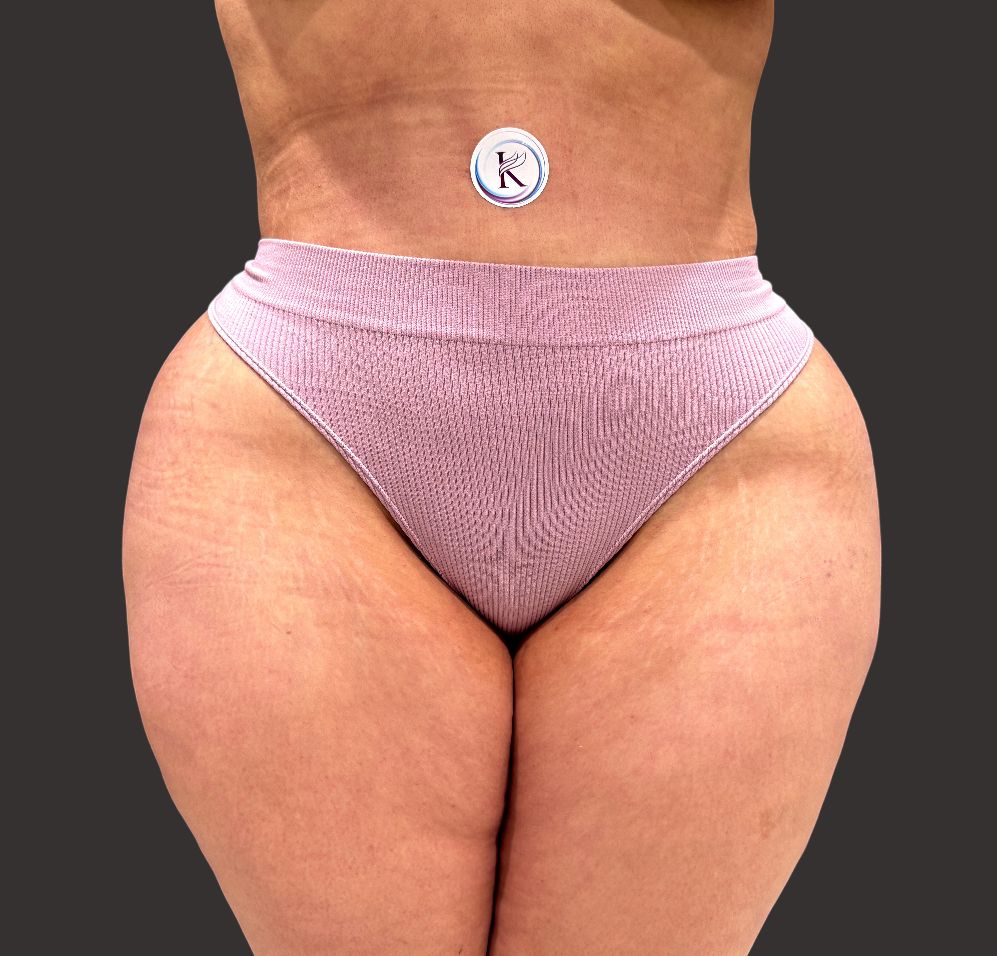 Case--8285-Tummy-Tuck | After Tummy Tuck