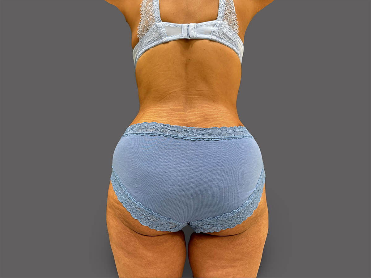 Case--3307-Liposuction | After Body