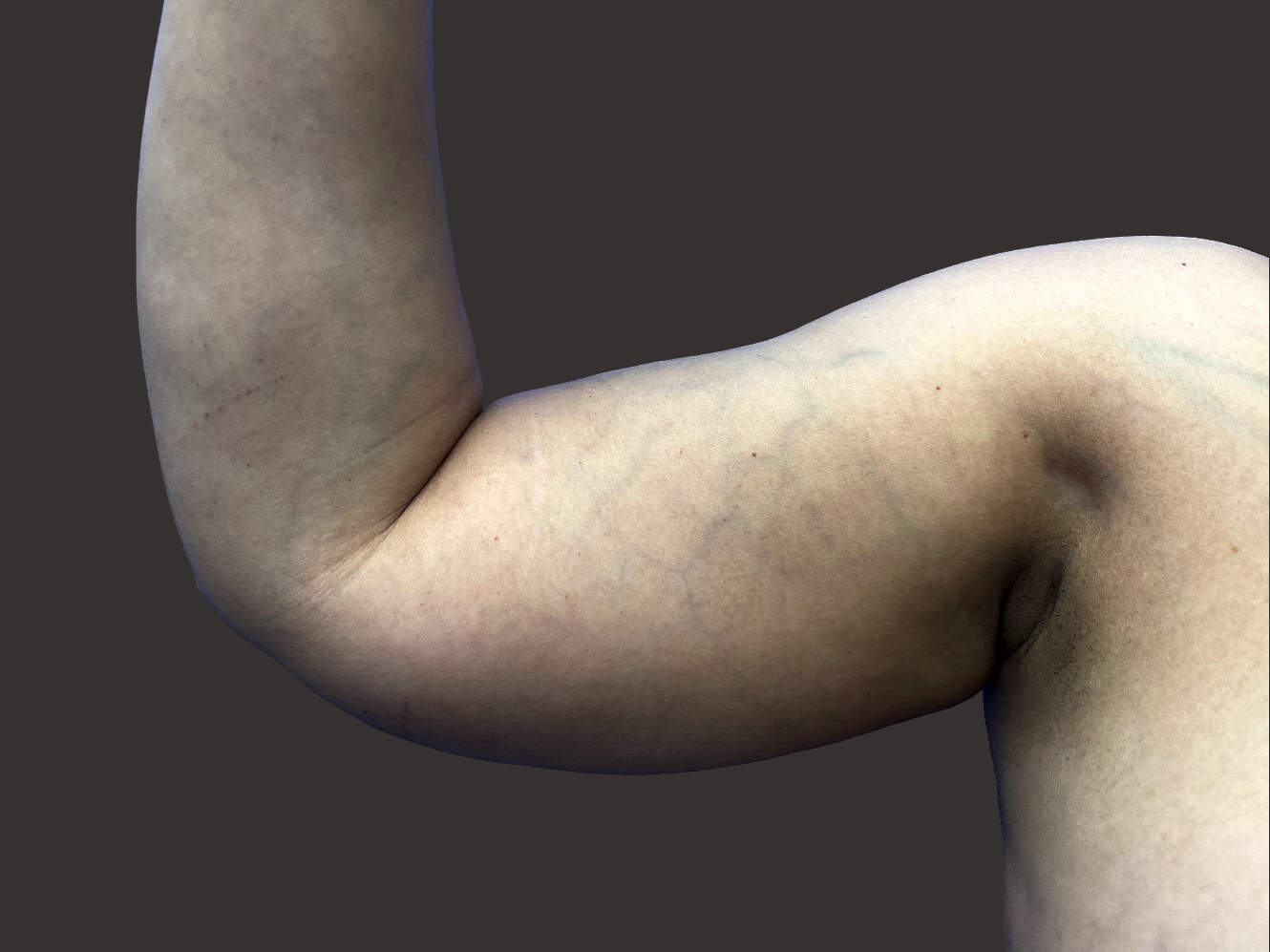 Case--2107-Arm-Tuck | Before Body