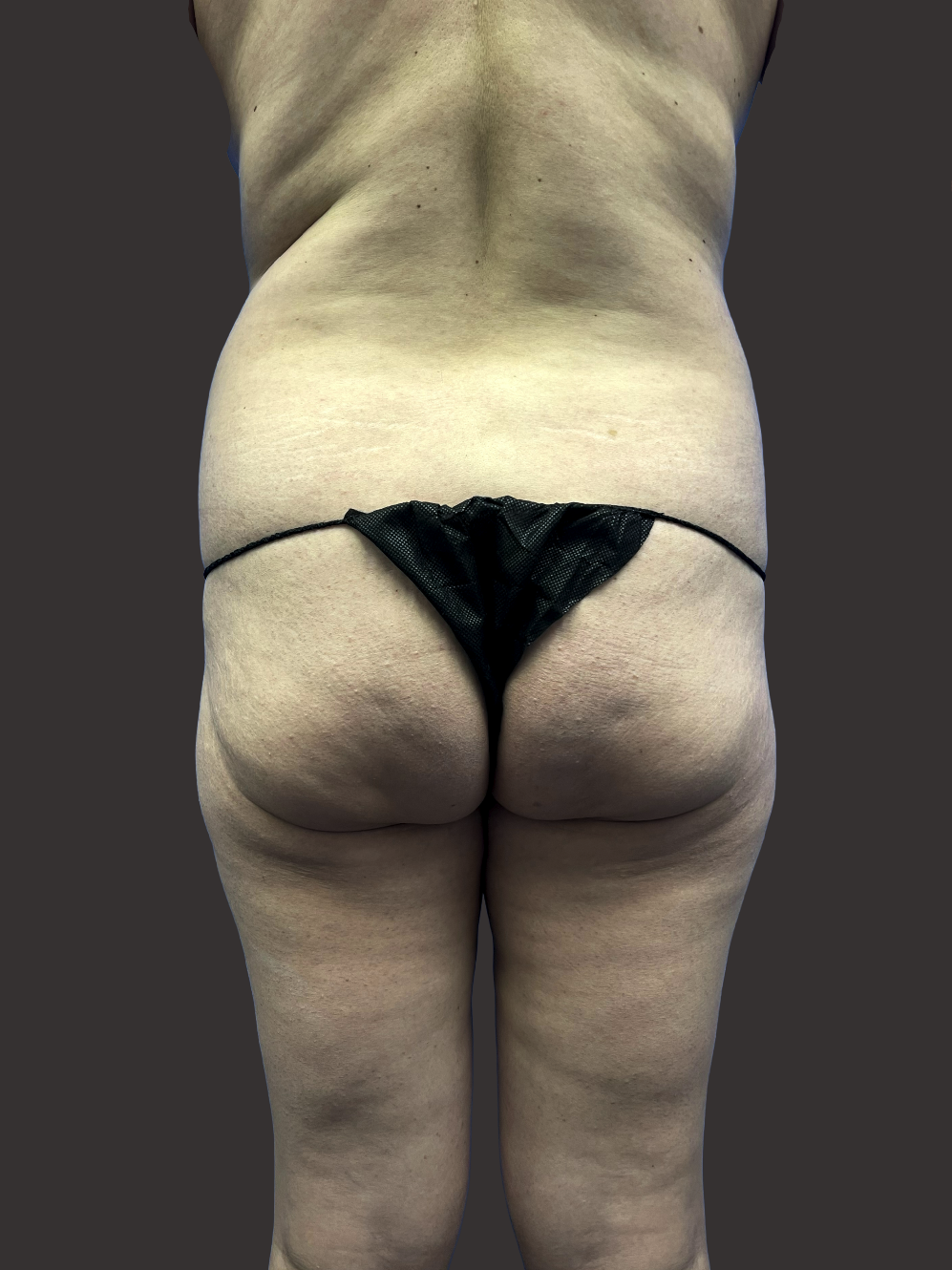 Case--8320-Liposuction | Before Liposuction