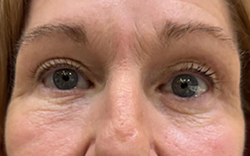 Case--3786-Eyelid-Lift | After Eyelid Lift