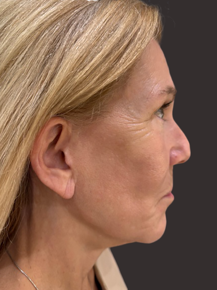 Case--7304-Facelift | After Facelift