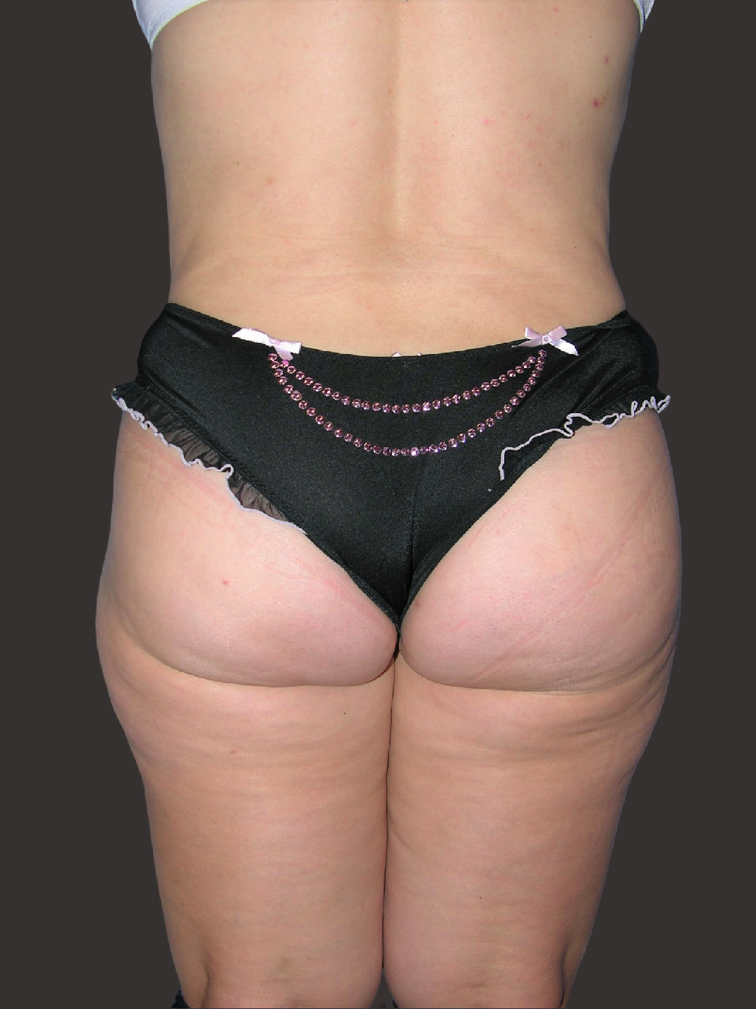 Case--3359-Liposuction | After Liposuction