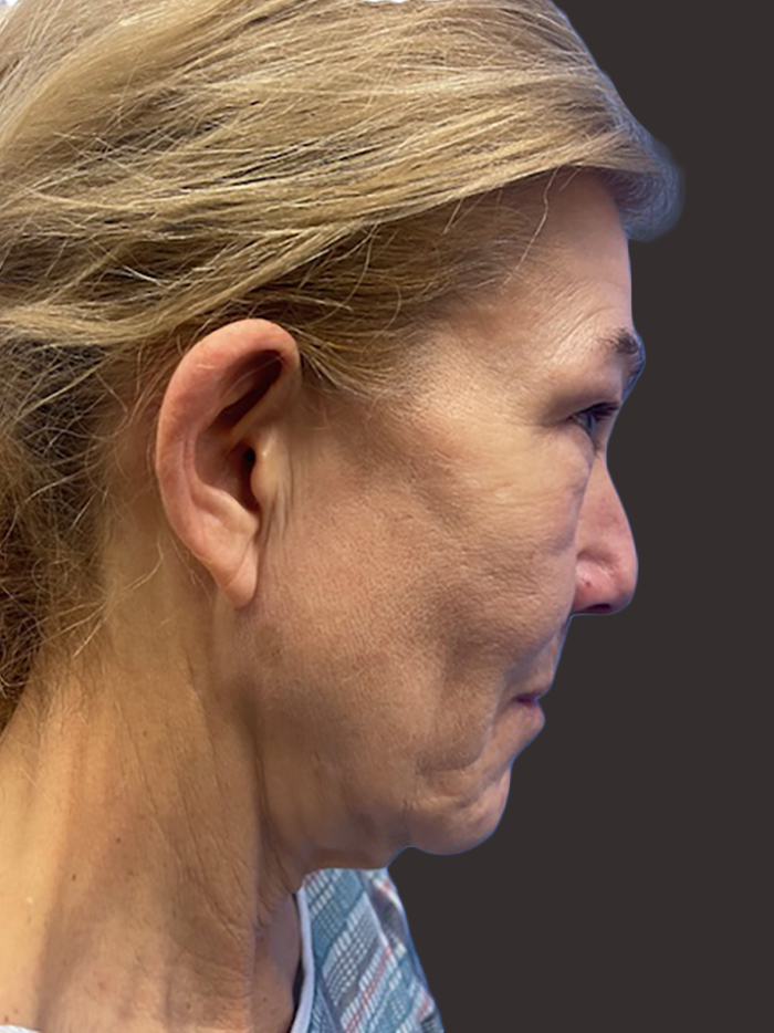 Case--7304-Facelift | Before Facelift