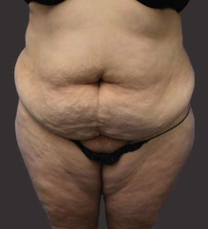 Case--5301-Tummy-Tuck | Before Tummy Tuck