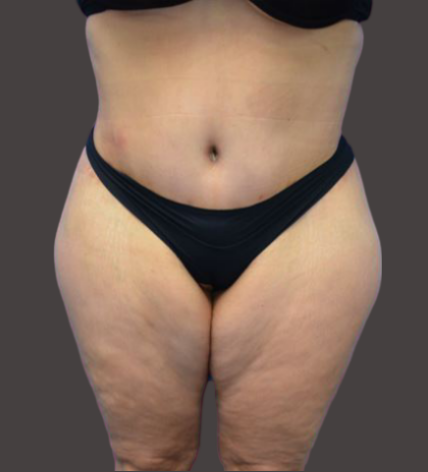 Case--5301-Tummy-Tuck | After Tummy Tuck