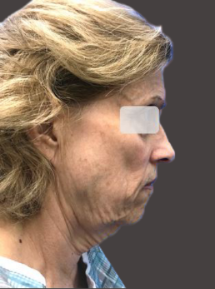 facelift beverly hills