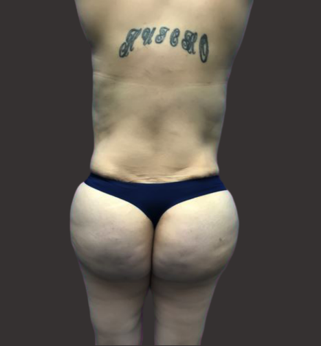 Case--9213-Brazilian-Butt-Lift | After Brazilian Butt Lift