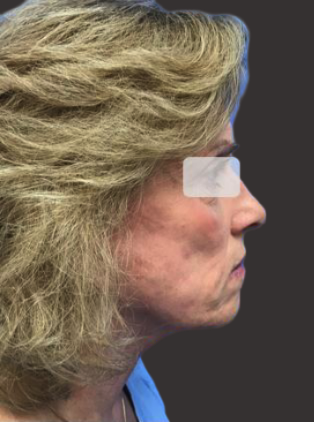 facelift beverly hills