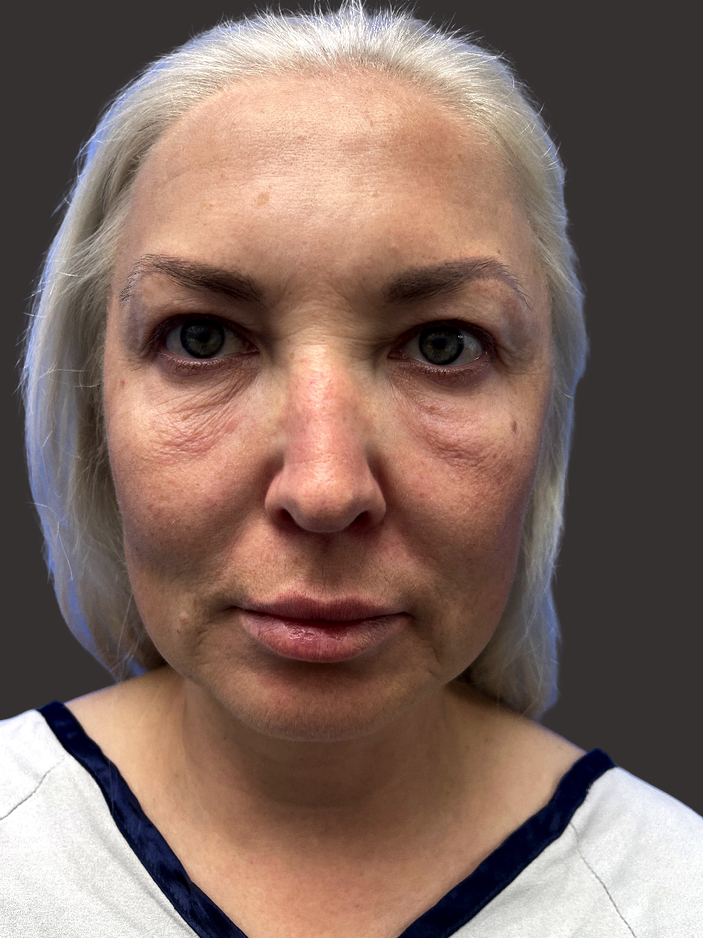 Before Facelift Gallery - Bruce Kadz Beverly Hills Plastic Surgery