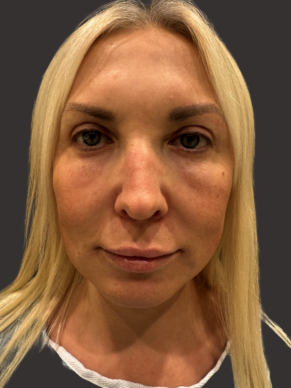 After Facelift Gallery - Bruce Kadz Beverly Hills Plastic Surgery