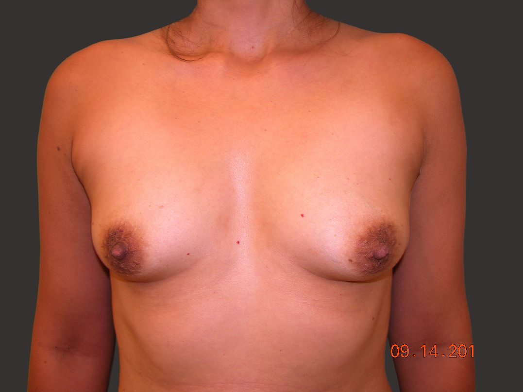 Case--7530-Breast-Augmentation | Before Breast Augmentation