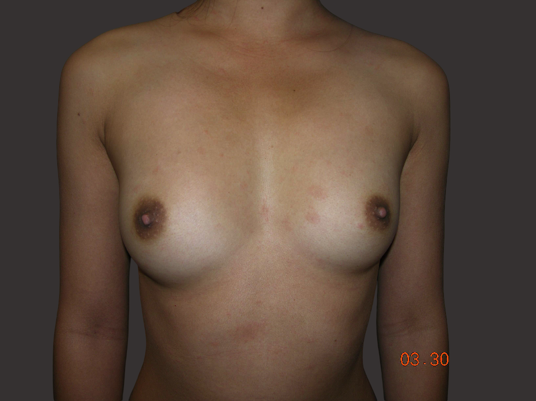 Case--4495-Breast-Augmentation | Before Breast Augmentation