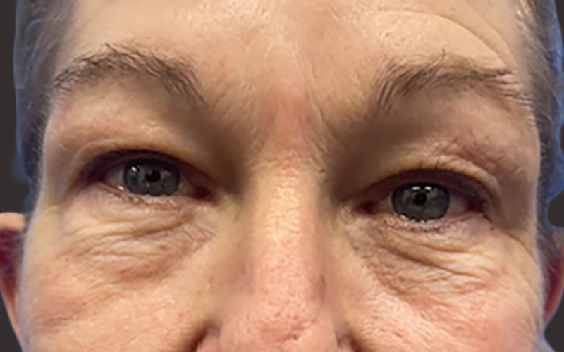 Case--3786-Eyelid-Lift | Before Eyelid Lift