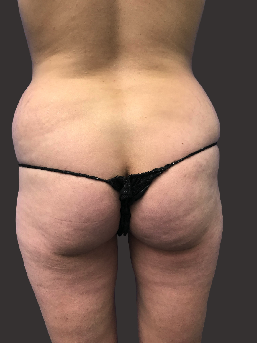 Case--2935-Liposuction | Before Body