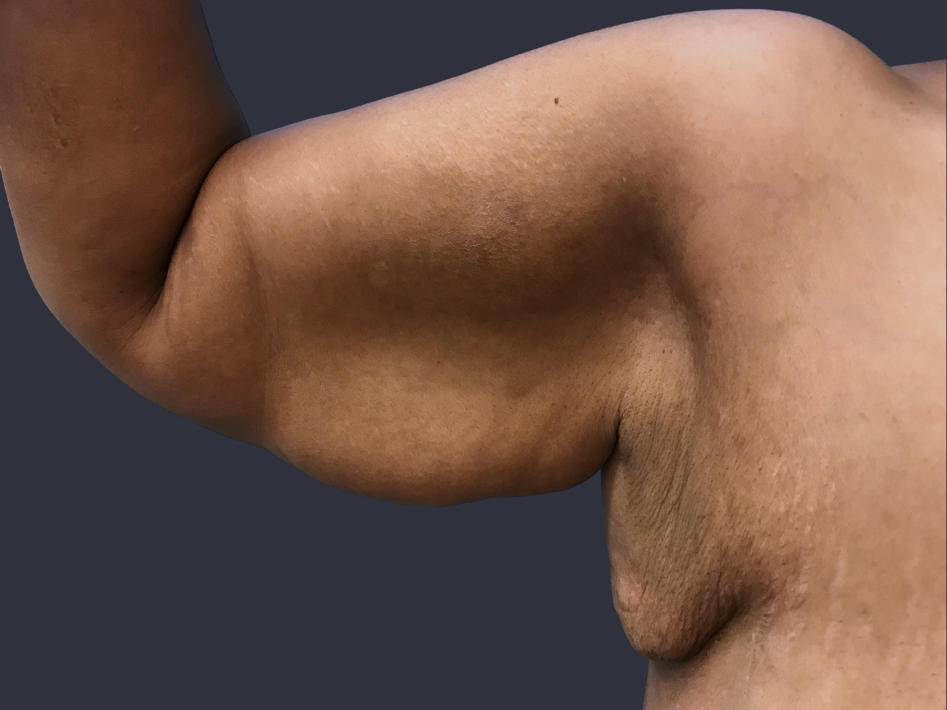 Case--5966-Arm-Tuck | Before Body