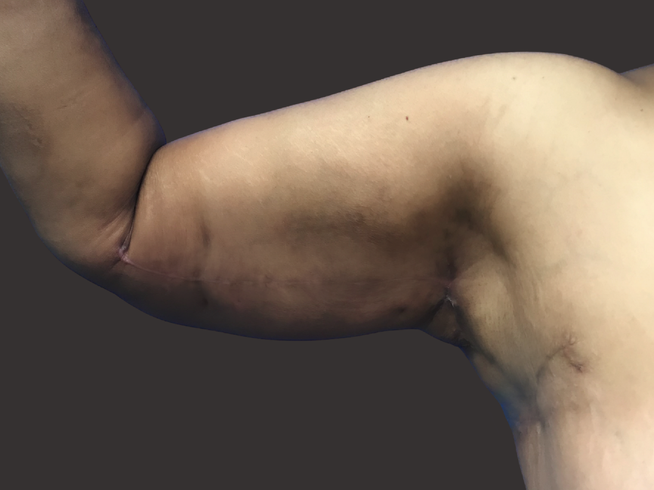 Case--5966-Arm-Tuck | After Body