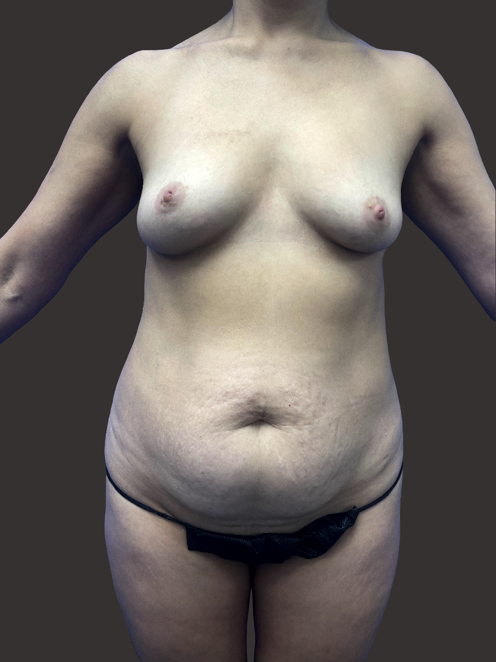 Case--2704-Tummy-Tuck | Before Tummy Tuck