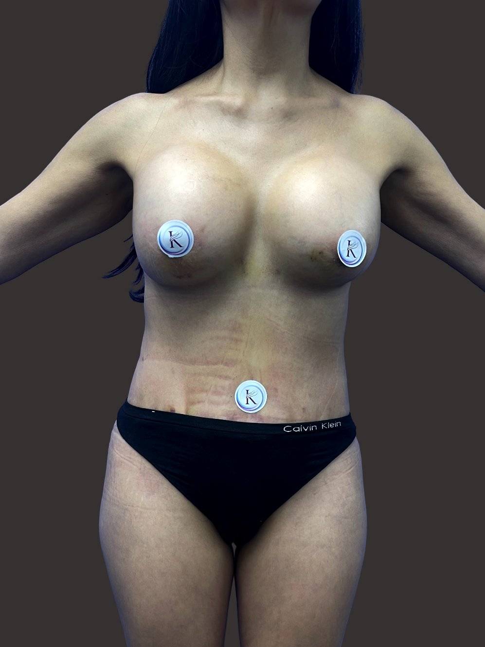 Case--2704-Tummy-Tuck | After Tummy Tuck