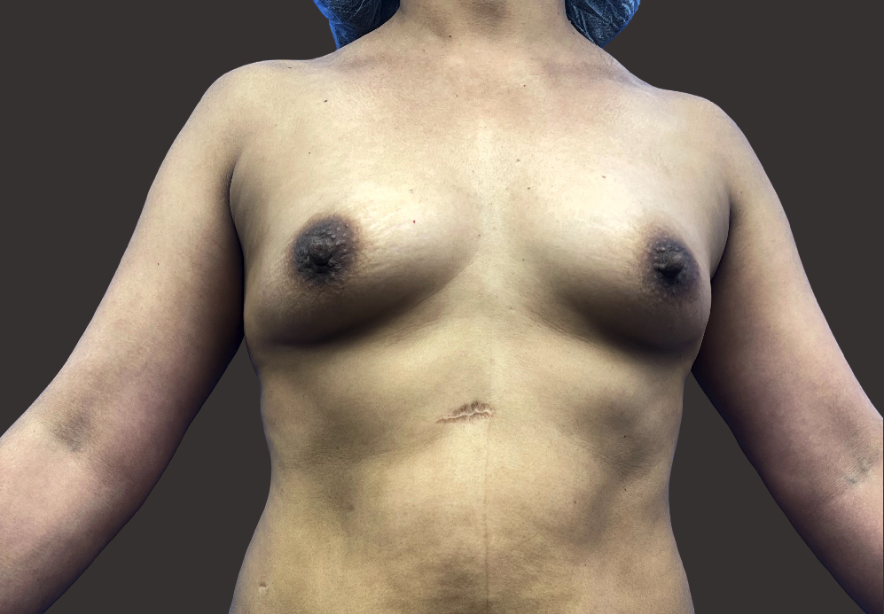 Case--9284-Breast-Augmentation | Before Breast Augmentation