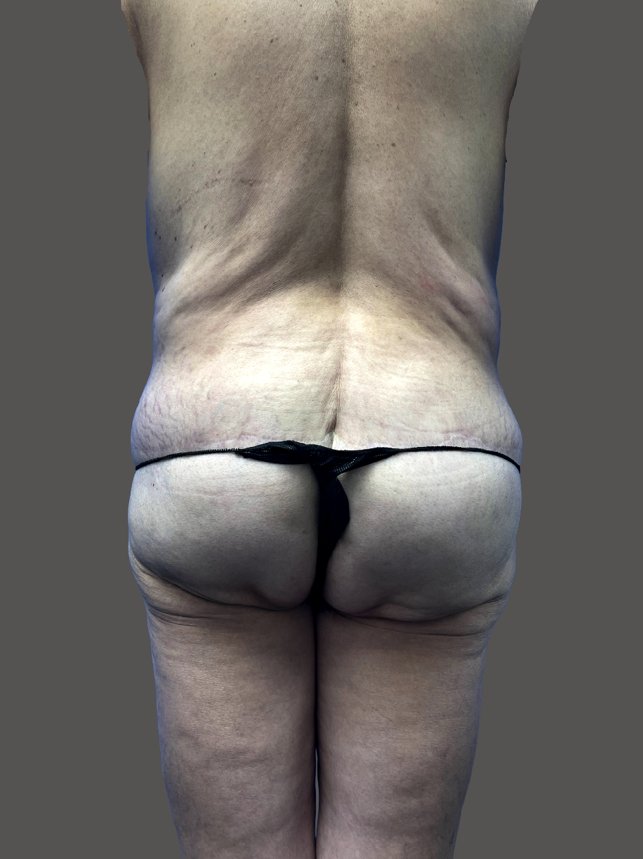 Case--3862-Liposuction | Before Liposuction