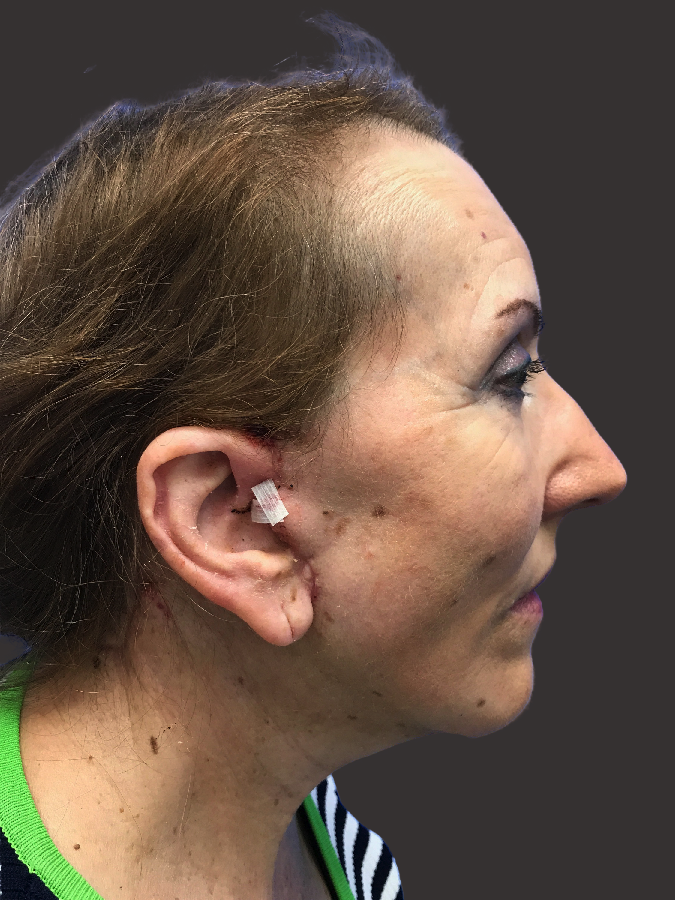 facelift beverly hills