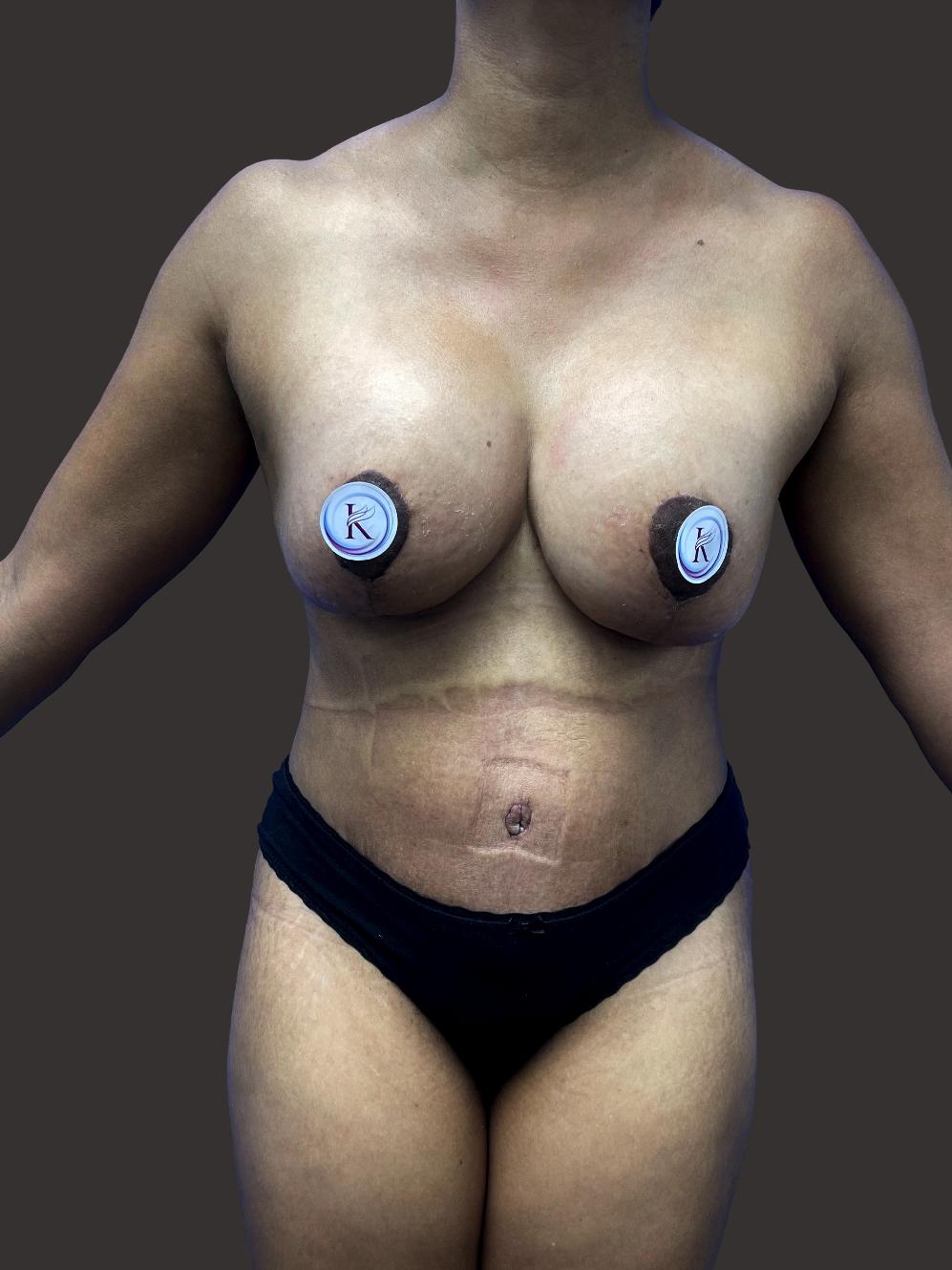 Case--7920-Mommy-Makeover | After Body