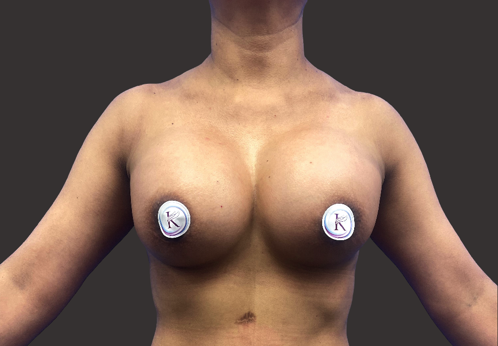 Case--9284-Breast-Augmentation | After Breast Augmentation